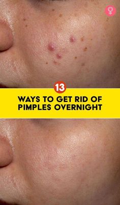 Pimples can make you feel less confident and take a toll on you mentally. But why worry when you can get rid of pimples with simple remedies. Check them out now! Zit Remedy, Get Rid Of Pimples Overnight, Rid Of Pimples Overnight, Redness Pimple, Small Pimples, Get Rid Of Pimples, Blind Pimple, Rid Of Pimples, Pimples Under The Skin