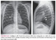 an x - ray image shows the chest and ribs, with arrows pointing in different directions