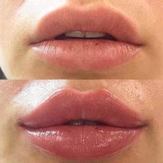 Lip Fillers Juvederm, Dermal Fillers Lips, Lips Fillers, Lip Surgery, Lips Shape, Heart Shaped Lips, Lips Inspiration, Botox Lips, Facial Fillers