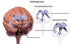 Can you treat schizophrenia naturally? Can you at least keep it under control? Read this article and find the answers to these questions. Thought Disorder, Mental Disorder, Health Disease, Nervous Breakdown, Brain Damage, Mental Disorders, Natural Remedy, Cognitive Behavioral Therapy, Behavioral Therapy