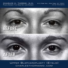 Dr. Thorne's upper (blepharoplasty) eyelid surgery technique https://charlesthornemd.com/face-surgery/blepharoplasty-eyelid-surgery.html - - #cosmeticsurgery #plasticsurgery #facelift #beforeandafter #plasticsurgeon #beauty #nyc #bestplasticsurgeon #newyork #facelift #surgery #beauty #chinimplant #transformation #beforeandafter #bestplasticsurgeon #blepharoplasty #doctor #necklift #boardcertifiedplasticsurgeon #eyes #eyelidsurgery Zendaya Eyebrows, Plucking Eyebrows, Filling In Eyebrows, How To Grow Eyebrows, How To Draw Eyebrows