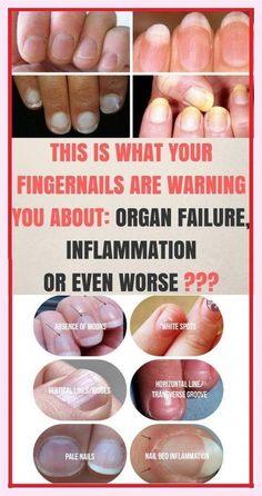 Fingernails Warning by Catherine Chapman | This newsletter was created with Smore, an online tool for creating beautiful newsletters for educators, businesses and more Pale Nails, Nail Conditions, Health Signs, Striped Nails, Nail Health, Healthy Beauty, Yellow Nails