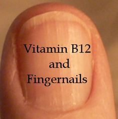 Low Vitamin B12, Fingernail Health, Health Signs, Natural Healing Remedies, Nail Health, Vitamin B12, Natural Health Remedies, Health Info, Natural Medicine