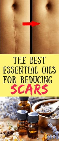 Oils For Scars, Oil Remedies, Diy Kosmetik, Magic Bullet, Scarring, Best Essential Oils, Oil Uses, Essential Oil Uses