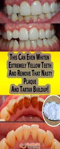 Going To The Dentist, Yellow Teeth, Teeth Health, Oil Pulling, The Dentist, Oral Health Care, Tooth Decay, Health Advice, Natural Medicine