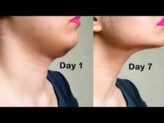 a woman's neck is shown before and after her lip fillup surgery procedure