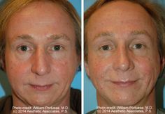 Wide nasal bones Nasal Cannula, Deviated Nasal Septum Before And After, Chin Augmentation