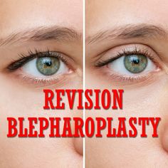 Revision Blepharoplasty 

https://charlesthornemd.com/blogs/
-
-
#cosmeticsurgery #plasticsurgery #facelift #plasticsurgeon #beauty #nyc #bestplasticsurgeon #newyork  #surgery #transformation #blepharoplasty #doctor #boardcertifiedplasticsurgeon #eyes #eyelidsurgery #cosmeticsurgeon #topplasticsurgeon #charlesthornemd #eyelids Facelift Surgery, Eyelid Lift, Nose Surgery, Excess Skin, Upper Eyelid, Neck Lift, Brow Lift, Eye Lift, Nose Job