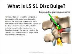 L5 S1 Disc Bulge.mp4 My daily pain, who can help? Meeting Room Booking System, Intervertebral Disc, Homeopathy Remedies, Hip Pain Relief, Bulging Disc