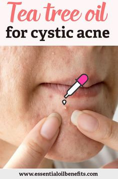 Discover the benefits of using tea tree oil for cystic acne and also the best 6 DIY recipes to cure your acne once and for all! Tea Tree Oil For Acne How To Use, Tree Tea Oil Uses Skin, Tee Tree Oil Benefits For Skin, Benefits Of Tea Tree Oil For Skin, Uses For Tea Tree Oil, How To Use Tea Tree Oil On Face, Tea Tree Oil Uses For Skin, Yea Tree Oil