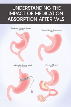 Medications are absorbed differently after bariatric surgery. Depending on the procedure and medication, make sure you discuss all medications with your surgeon. As general information, check out the overview so that you can learn about your procedure! #NSAIDS #bariatricsurgery #wls #weightlosssurgery #rny #gastricbypass #vsg #verticalsleeve #ds #duodenalswitch #lapband Duodenal Switch Surgery, Gastric Bypass Revision Surgery, Modified Duodenal Switch, Wls Before And After, Sadi-s Surgery, Sleeve Surgery Before And After, No Chew Foods After Surgery Bariatric, Gastric Bypass Before And After