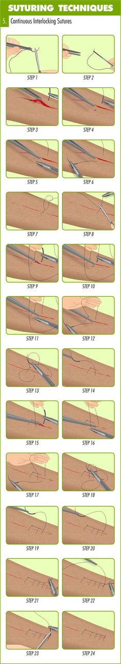 Continuous Interlocking Suture Suturing Technique Suture Techniques, Surgical Tech, Survival Life Hacks, Survival Techniques, Emergency Medicine, Survival Life, Medical Knowledge, Emergency Prepping, Survival Prepping