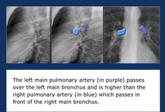 the left main artery in purple passes over the left man's bronchus and is higher than the right bul