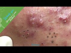 Ear Cysts Popping, Pimple Poppìng Videos Blackheads, Dr Pimple Popper Blackhead Youtube, Cystic Acne Removal Video, Satisfying Videos Popping Pimples, Poping Pimples Videos New, Pimple Pops Videos, Mr Pimple Popper, Big Blackheads Removal Satisfying Videos