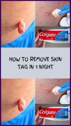 How to Remove Skin Tag in 1 Night Remove Skin Tags, Remove Skin Tags Naturally, Skin Tags, Natural Sleep Remedies, Natural Cold Remedies, Natural Cough Remedies, Cold Home Remedies, Cough Remedies, 1st Night