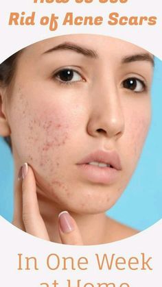 Acne Scar Remedies, Getting Rid Of Scars, Back Acne Remedies, Scar Remedies, Acne Scaring, Acne Tips, Pimple Scars, Acne Overnight, Get Rid Of Acne