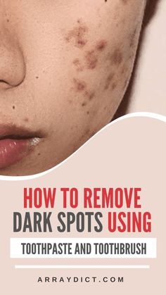 Skin Spot Remover, Benefits Of Moringa