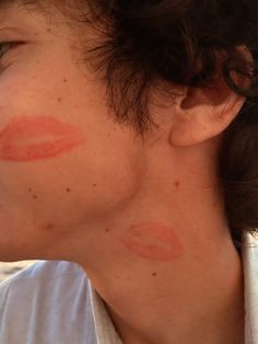 a woman with red spots on her face and neck, looking off to the side