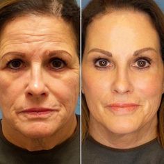 She was detained by border control because of the extremely effective anti-aging facial care invented by her daughter Anti Aging Mask, Aging Face, Skin Care Wrinkles, Skin Dryness, Face Wrinkles, Health Planner, Anti Aging Facial, Anti Aging Ingredients, Anti Aging Moisturizer