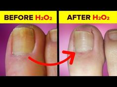 In this article, we share a step-by-step guide of how to use hydrogen peroxide for nail fungus. Learn how it works along with some safety and precautionary tips. Toenail Health, Toenail Fungal Infection, Nail Remedies, Nail Fungus Remedy, Nail Infection, Fungal Nail, Ingrown Toe Nail, Toenail Fungus, Nail Fungus