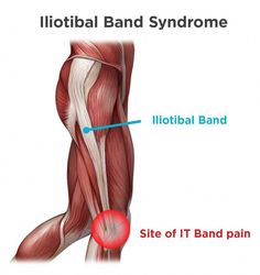 a diagram showing the location of the lumbal band syndrome and how it works