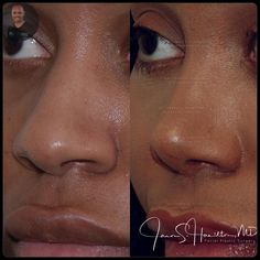 Mommy Makeover Surgery, Rhinoplasty Surgery