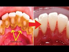 Baking Soda Teeth, Going To The Dentist, Makeup Life Hacks, Kedokteran Gigi