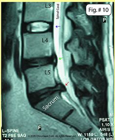 L4, L5, S1 Disc Damage Often Caused by Tight Iliopsoas Muscles Hip Flexor Stretch, Tight Hip Flexors, Joints Pain Relief