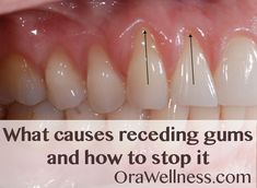 Gum Recession, Stronger Teeth, Oil Pulling