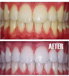 Put a tiny bit of toothpaste into a small cup, mix in one teaspoon baking soda plus one teaspoon of hydrogen peroxide, and half a teaspoon water. Thoroughly mix then brush your teeth for two minutes. Remember to do it once a week until you have reached the results you want. Once your teeth are good and white, limit yourself to using the whitening treatment once every month or two by morecerv. Tooth Whitening, Brush Your Teeth, Periodontal Disease, Oil Pulling, Hydrogen Peroxide, Dental Hygienist