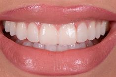 Teeth Claims For Dr, Dream Teeth, Smile White Teeth, Smile Tips