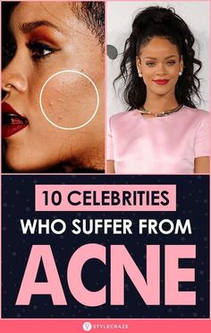 10 celebration who support from acne Celebrities With Acne, Celebrity Acne, Pictures Of Celebrities, Amazing Makeup, Hormonal Acne, Not The Only One, Face Acne, A Thought