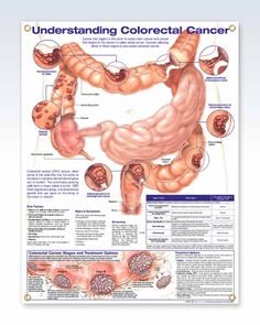 This 2nd edition exquisitely detailed 20" x 26" (51 x 66 cm) examination-room anatomy poster with grommets defines colorectal cancer showing anatomy with the following five pathologies: Adeno­carcinoma of colon, circumferential carcinoma of transverse colon, colonic polyps, adeno­carcinoma of jejunum, and adeno­carcinoma of recto­sigmoid region. This is one of the best laminated anatomy posters for oncologists and gastro­enerologists. Published by Wolters Kluwer. ©2022 Order at least 2 please Laminated with 2+ corner grommets Includes cancer staging Oncology Nursing, Medical Coding, Nursing Tips, Med Student, Nursing Notes