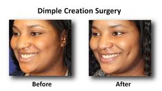 Dimple Surgery Before And After, Fake Dimples, Dimple Surgery, One Dimple, Local Anesthesia, Side Of Face, Face Surgery, Cosmetic Procedures, Body Chain Jewelry