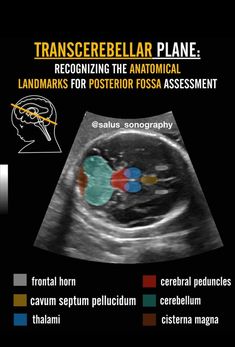 an mri scan with the text transsebellar plane recognizing the anatomical landmarks for posterior fossa assessment