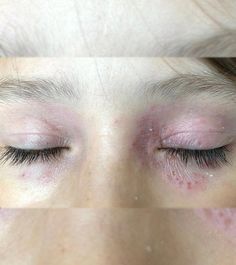 Generally, when an eruption appears around the eyes, it is accompanied by itchiness. But these 12 home remedies for rash around the eyes can help. Click here. Face Allergic Reaction, Eye Irritation Remedies, Itchy Eyes Remedy, Face Rash Remedies, Skin Irritation Remedies, Home Remedies For Rashes, Dry Skin Around Eyes, Home Remedies For Face, Rash On Face