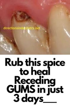 Tooth Scaling, Grow Back Receding Gums, Fix Teeth, Tooth Decay Remedies, Teeth Health, Oral Care Routine, Gum Care, Receding Gums