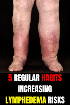 Common regular habits that can cause lymphedema may include lack of exercise, injury, wearing constrictive clothing, excessive sun exposure, and ignoring precautions after surgery. #lymph #lymphedema #lymphnodes #lymphoma Lymph Drainage Massage, Neck Tension, Lymph Massage, Lymph System, Lymph Drainage, Swollen Legs, Fluid Retention, Home Health Remedies, Immune Health