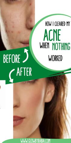 Looking for an acne face wash that actually works? Check this pharmacist Guide on the best acne face wash acne face wash, acne face wash best, acne face wash for sensitive skin, face wash for acne prone skin, face wash for acne, face wash for acne and oily skin, cleanser for acne, acne skincare routine, how to treat acne at home, salicylic acid cleanser, face wash for cystic acne, Face Wash For Oily Skin Acne, Best Acne Products, Acne Free Skin