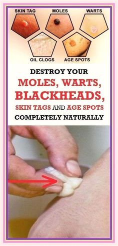 Did You Know that You Are Able to Get Rid of Your Moles, Warts, Blackheads, Skin Tags and Age Spots In a Completely Natural Way?!? How To Remove Pimples, Cold Home Remedies, Homemade Face Masks, Homemade Face