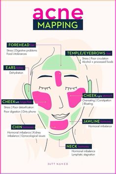 It doesn’t matter if you’re a teen suffering from acne, or an adult suffering from acne related to stress or hormones; it hurts to have acne. I know what it’s like to suffer from acne and not know where to turn to for acne help. So, here are all the effective treatments for acne with some additional skin-care tips to prevent it from ever happening: Acne Map, How To Treat Pimples, Different Types Of Acne, Face Mapping Acne, Forehead Acne, Skin Diet, Acne Help, Face Mapping, Acne Treatments