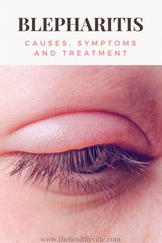 Blepharitis is a pathology consisting of inflammation of the free edge of the eyelid. It is necessary to treat it correctly to avoid complications. Eye Irritation Remedies, Swollen Eye Remedies, Swollen Eye, Stye Remedies, Swollen Eyelid, Dry Eyelids, Old Remedies, Allergy Eyes, Importance Of Sleep