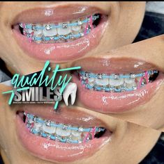 Star Shaped Braces, Cotton Candy Braces, Braces Color Patterns, Braces Colors With Rubber Bands, 2 Braces Colors Ideas, Braces And Dimples, Braces With Power Chains, Braces For Overbite