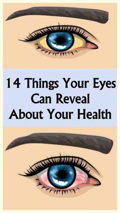 14 Things Your Eyes are Trying to Tell You About Your Health Protruding Eyes, Computer Vision Syndrome, Eyes Problems, Computer Vision, Eye Strain, Eye Health, Healthy Tips, Home Remedies