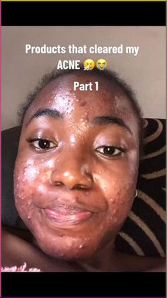 Struggling with severe acne? I've been there. Check out my journey to clear skin with budget-friendly products that actually work. Don't let acne dim your glow, let's conquer it together! ✨ #AcneFree #ClearSkinJourney Forehead Acne, Skincare Hacks, Bad Acne, Oily Sensitive Skin, Face Care Routine, Serious Skin Care, Severe Acne, Routine Skincare, Skin Clear