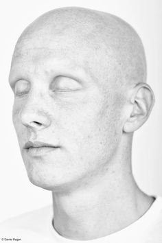 Albino People, Natural Asthma Remedies, Powerful Photos, Asthma Remedies, Photos Of People, Lung Disease, Asthma Attacks, Relaxation Techniques, Create Awareness