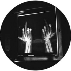 an x - ray image of two hands in front of a screen with the skeleton visible