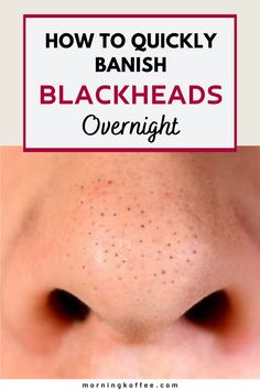 How To Get Rid Of Blackheads Naturally - MorningKo Home Remedies For Pimples, Blackheads On Nose, Pimples Overnight, Rid Of Blackheads, Black Heads, Pimples Remedies, Cold Medicine, Pore Strips, How To Get Rid Of Pimples