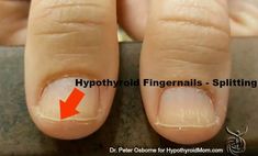 Do you have hypothyroidism? Look at your hands | Hypothyroid Mom