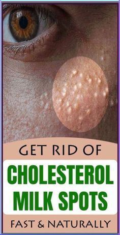 7 Remedies To Get Rid Of Cholesterol Milk Spots Naturally – Koperacija The milia, which is as well known as milk spots, is actually a harmless skin disorder which manifests in the form of small white... Bill Tracker, Dream Symbols, Men's Health Fitness, What Happened To You, Health Remedies, Hair Removal, Natural Remedies, Fitness Tips